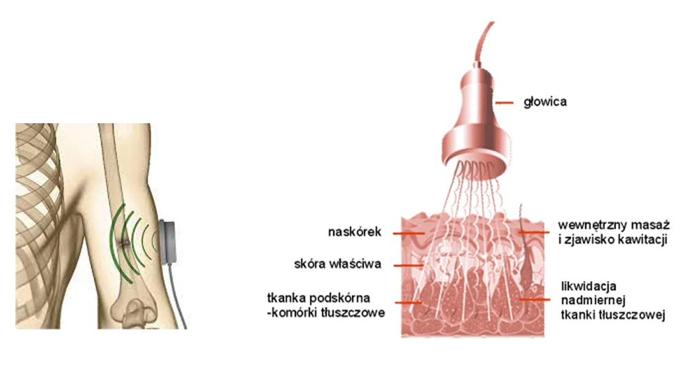 ULTRADŹWIĘKI